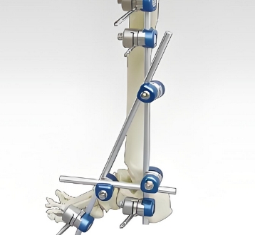 單臂式骨科外固定支架乾瑞